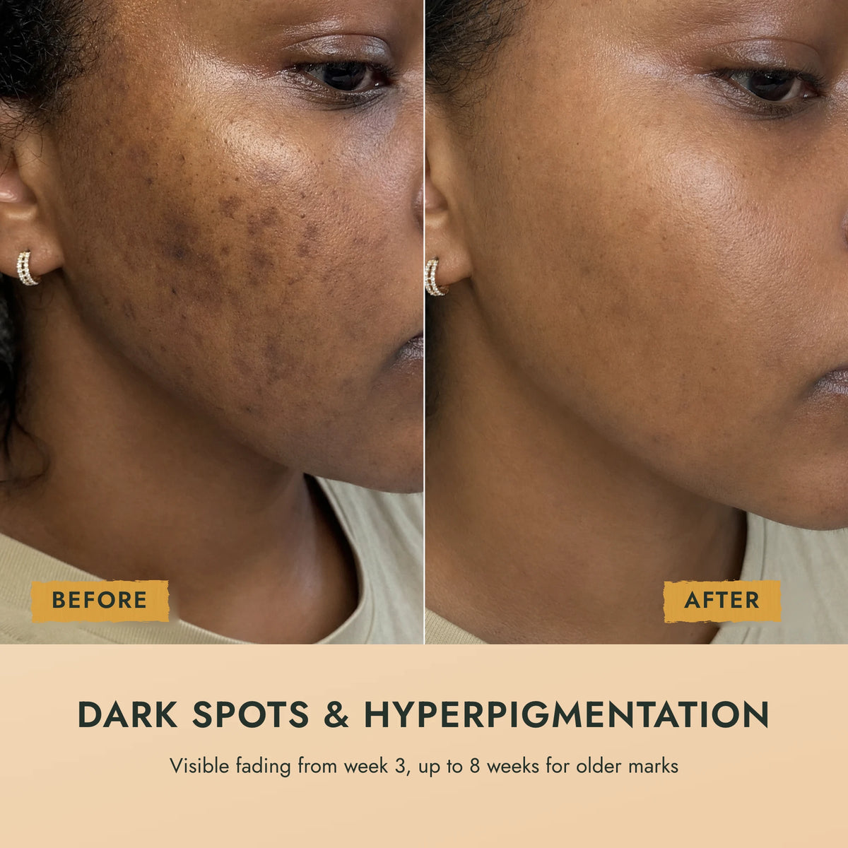 Dark Spots Out Bar™