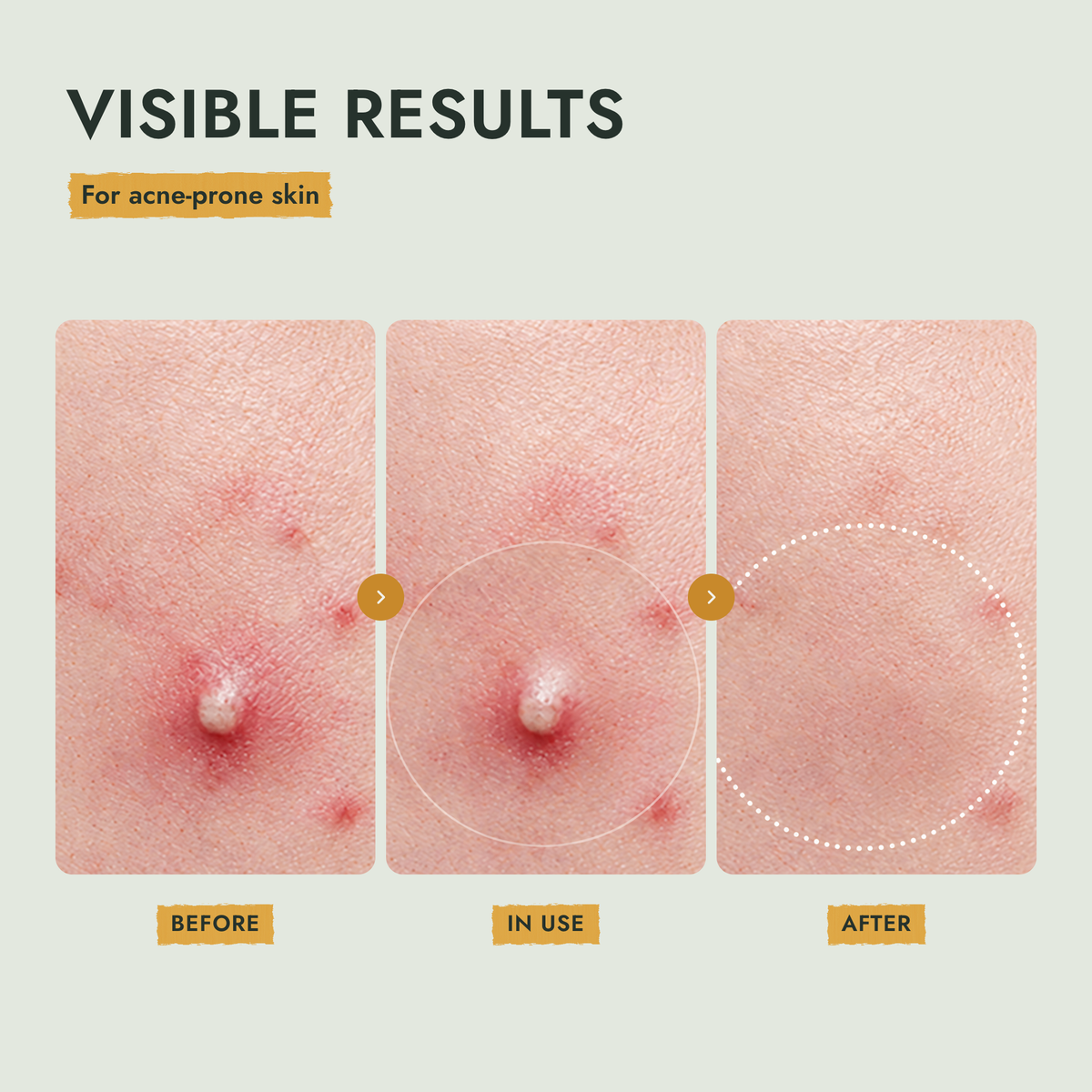 Before, during and after wearing a pimple patch on acne-prone skin