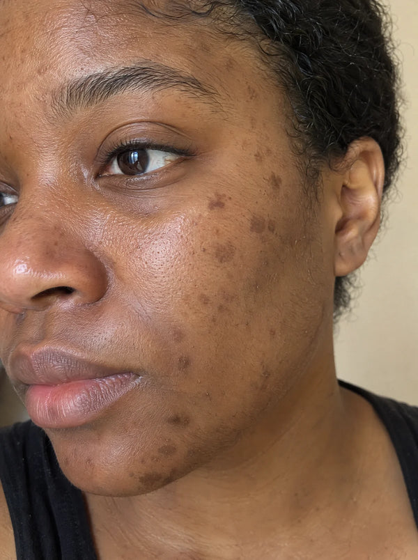 Dark marks on the face